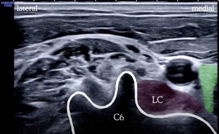 A patient was in refractory ventricular fibrillation. a third shock